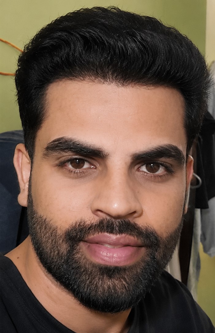 Natural hair growth after hair transplant treatment at Dexa Clinic